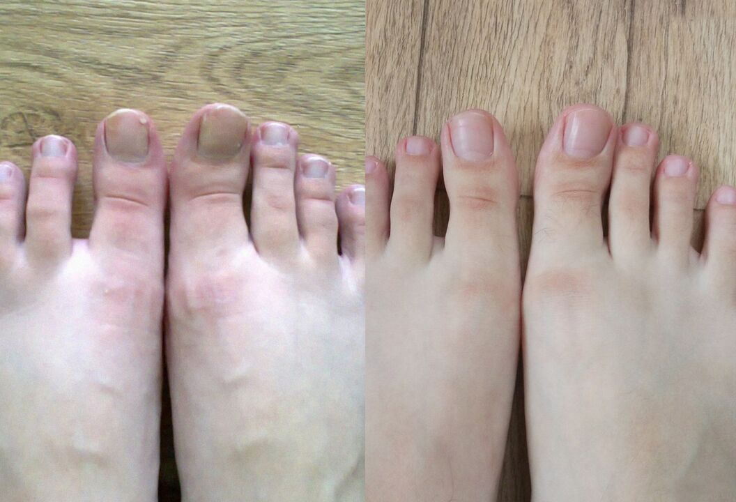 Voor en na behandeling, de Fungus Promisil Cream