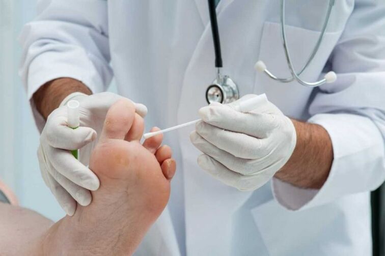 Die nagelschimmel behandelt