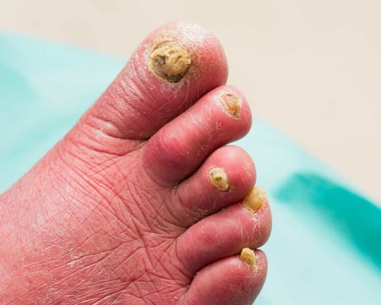 Symptomen van onychomycosis