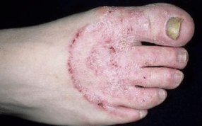 De redenen voor het verschijnen van de schimmel op de benen