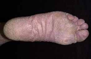 Tekenen en symptomen van schimmel op de benen