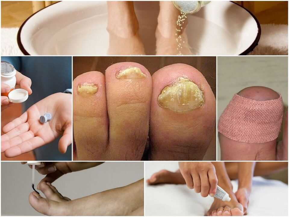 Behandeling van nagelschimmel
