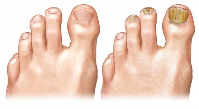 Gezonde en geïnfecteerde nagels nagels