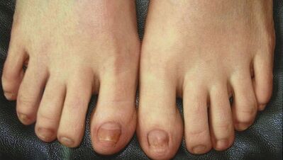 Stadia van ontwikkeling van nagelschimmel