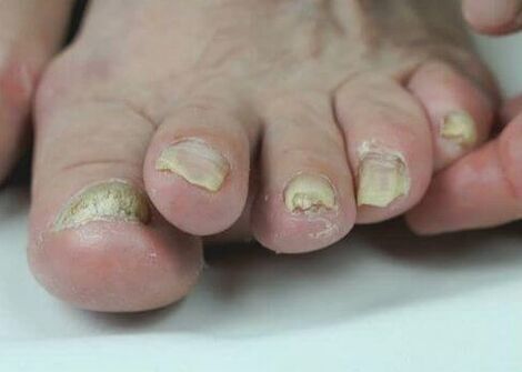 behandeling van nagelschimmel met medicijnen