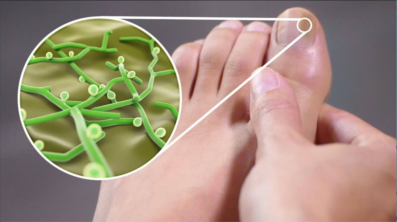 ziekteverwekkers van teennagelschimmel