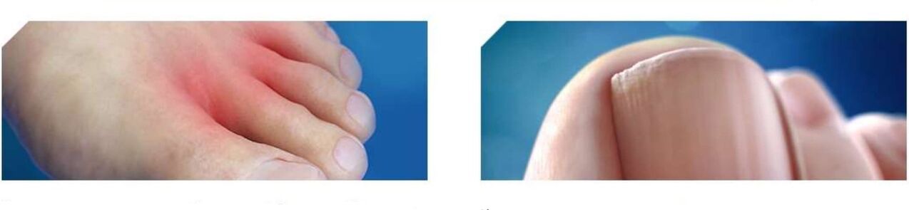 beginstadium van voetschimmel